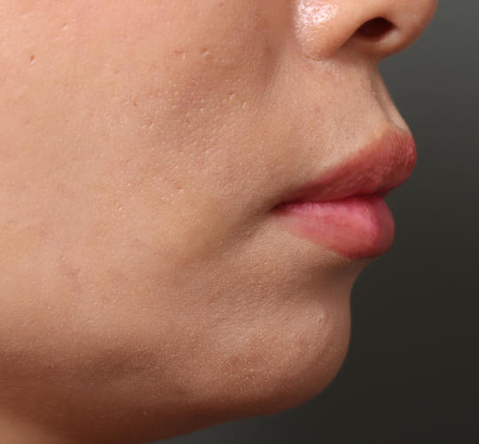 40代女性の人中短縮（リップリフト） Before 症例写真