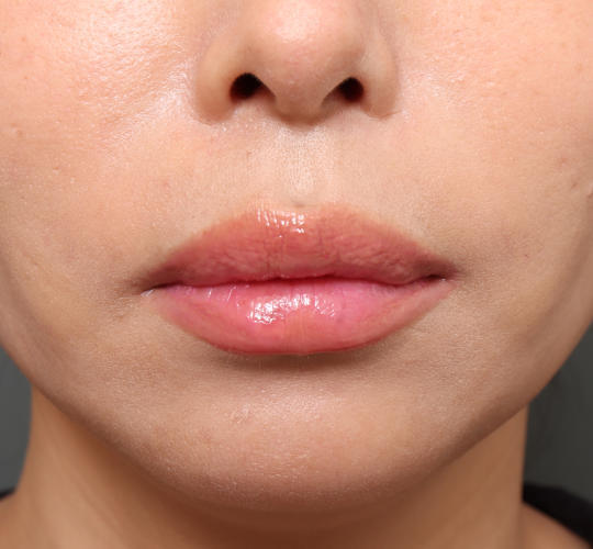 40代女性の人中短縮（リップリフト） Before 症例写真