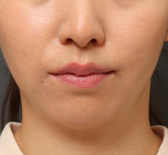 20代女性の唇・口元の整形 After 症例写真