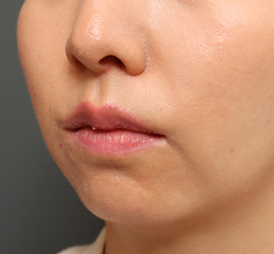 20代女性の人中短縮（リップリフト） After 症例写真
