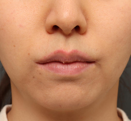20代女性の人中短縮（リップリフト） After 症例写真