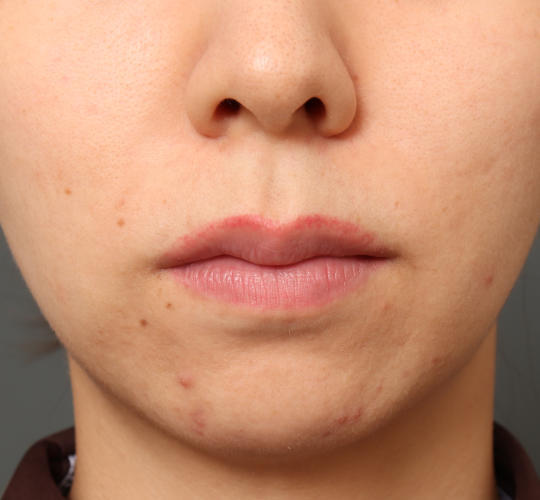 20代女性の人中短縮（リップリフト） Before 症例写真