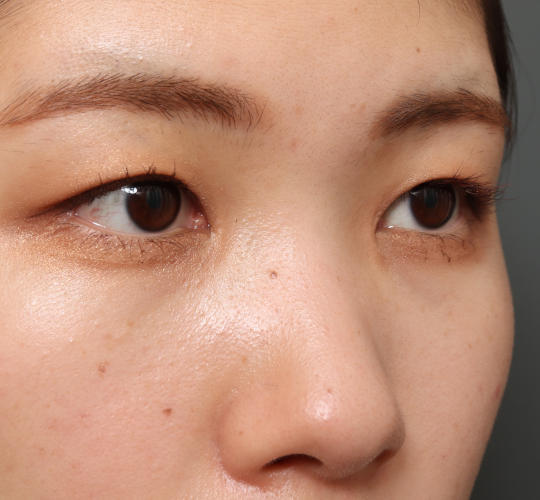 20代女性の目頭切開 After 症例写真