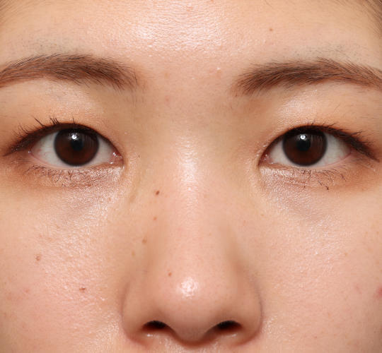 20代女性の二重整形・目元の整形 After 症例写真