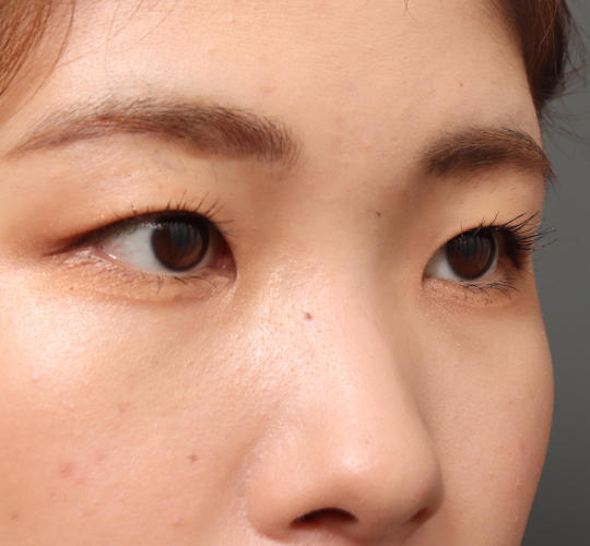 20代女性の目頭切開 Before 症例写真