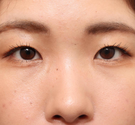 20代女性の二重整形・目元の整形 Before 症例写真