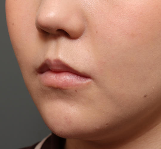 20代女性の人中短縮(リップリフト) After 症例写真