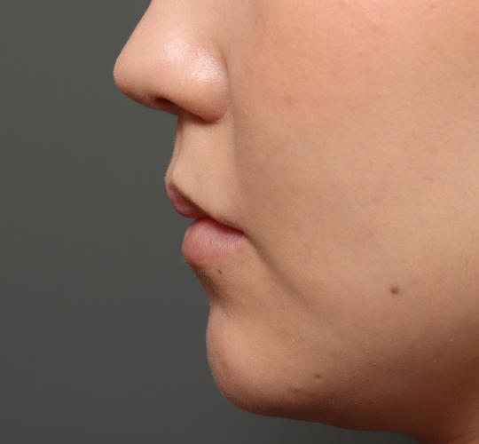 20代女性の人中短縮(リップリフト) After 症例写真