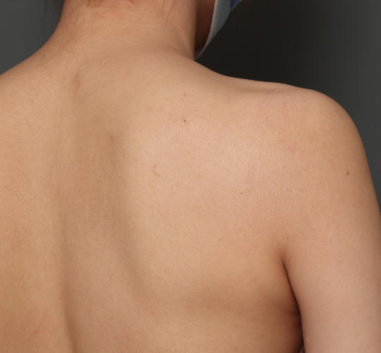 20代女性のボトックス(美肩・肩こり解消) After 症例写真