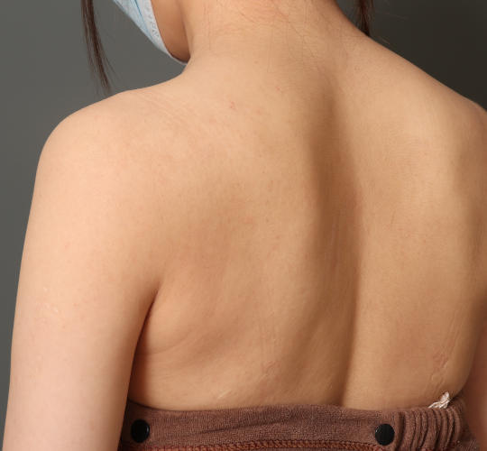 20代女性のボトックス(美肩・肩こり解消) Before 症例写真