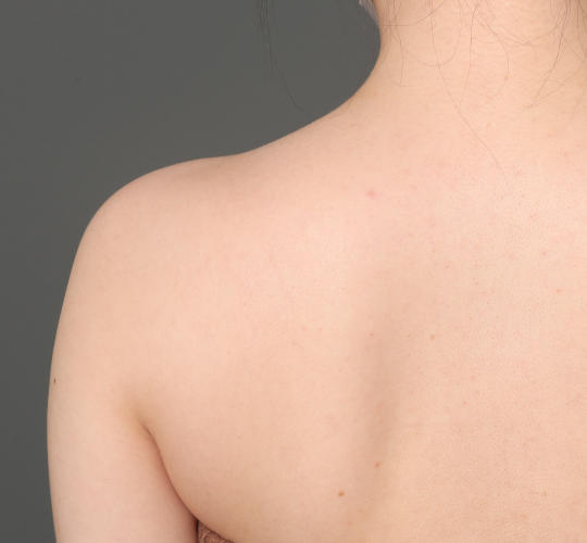 20代女性のボトックス(美肩・肩こり解消) Before 症例写真