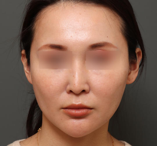 30代女性の鼻の整形 After 症例写真