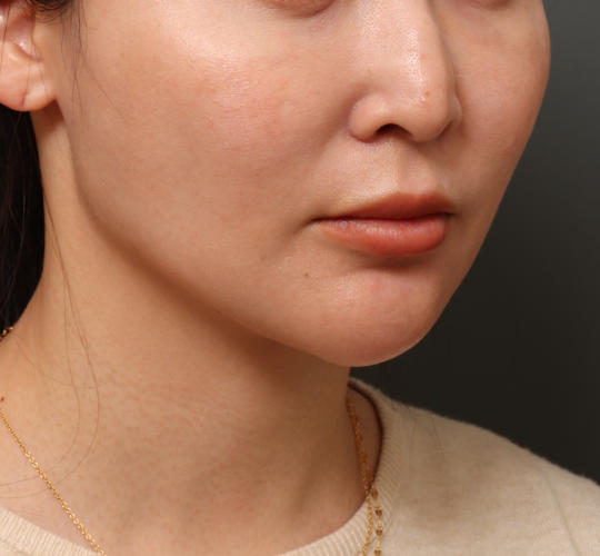 30代女性のヒアルロン酸注射  After 症例写真