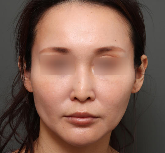 30代女性の鼻の整形 Before 症例写真