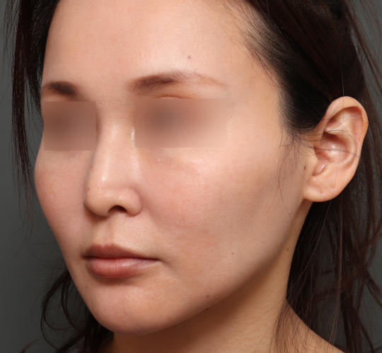 30代女性のヒアルロン酸注射  Before 症例写真