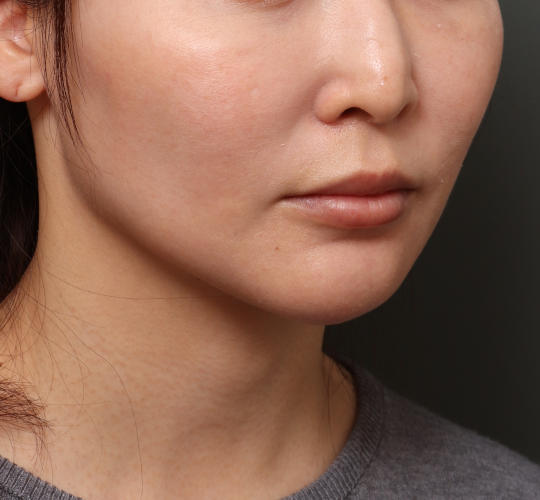 30代女性のヒアルロン酸注射  Before 症例写真