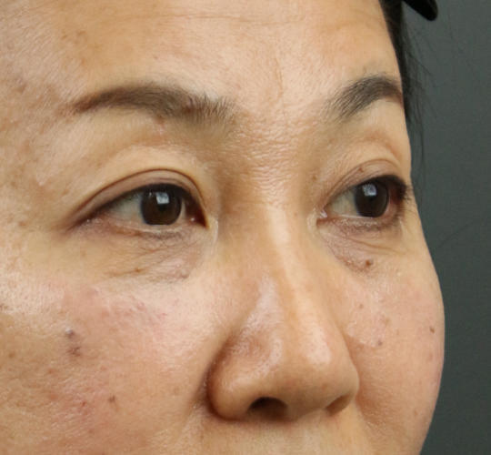 50代女性のヒアルロン酸注射（目の下） After 症例写真