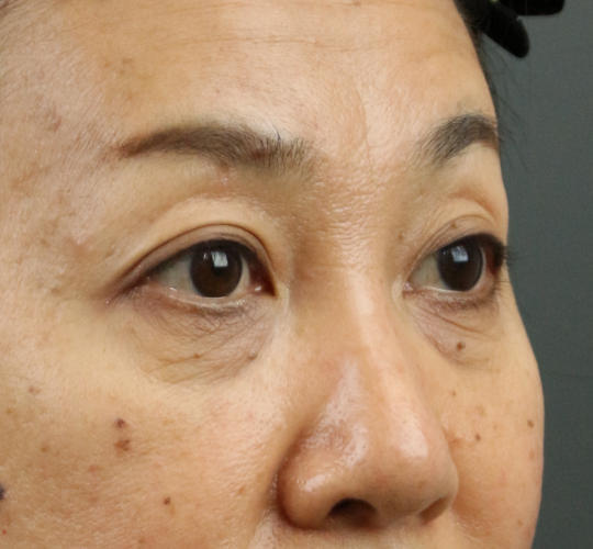50代女性のヒアルロン酸注射（目の下） Before 症例写真
