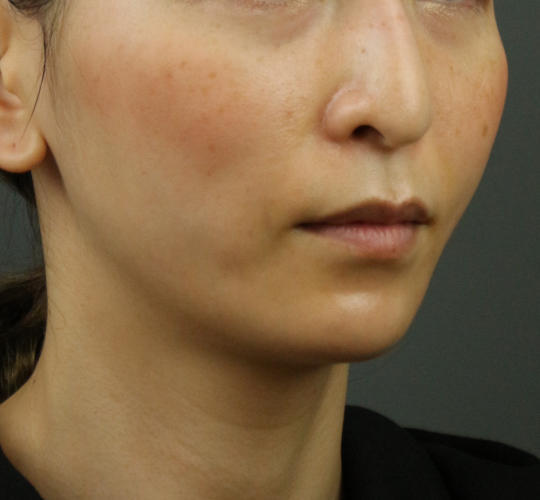 30代女性のVOVリフトプレミアム After 症例写真