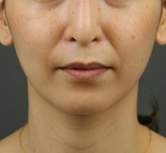 30代女性のVOVリフトプレミアム Before 症例写真