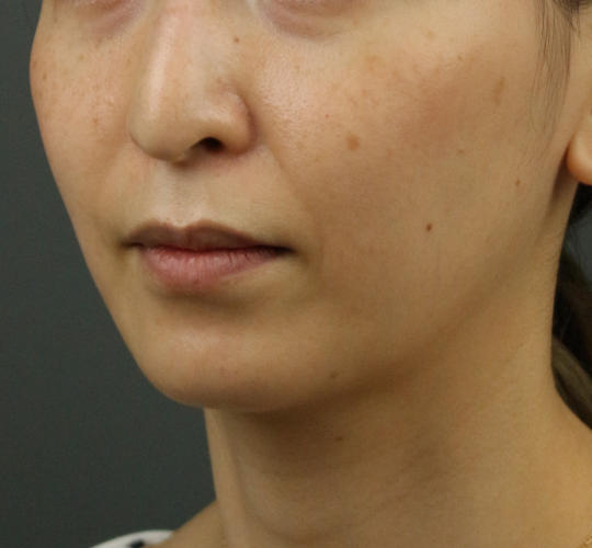 30代女性のVOVリフトプレミアム Before 症例写真