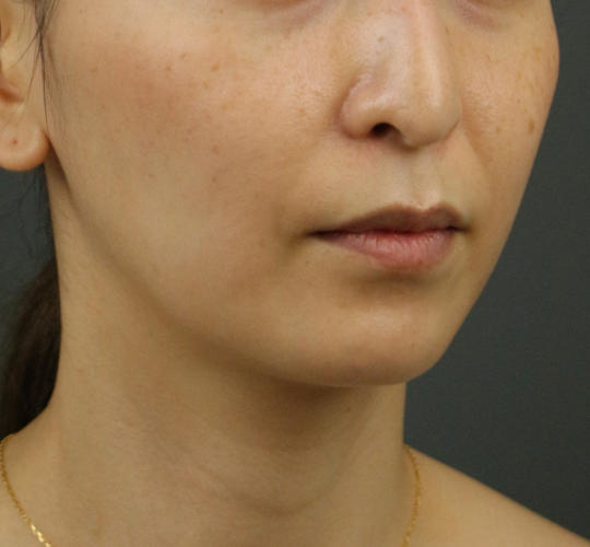 30代女性のVOVリフトプレミアム Before 症例写真