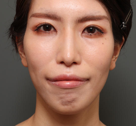 30代女性の眉下切開法 After 症例写真