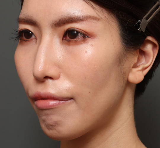 30代女性の鼻翼縮小(小鼻縮小) After 症例写真