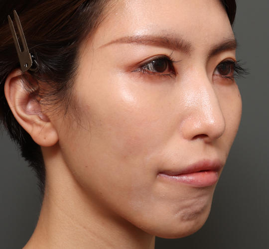 30代女性の鼻翼縮小(小鼻縮小) After 症例写真