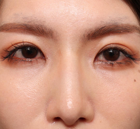 30代女性の鼻翼縮小(小鼻縮小) After 症例写真