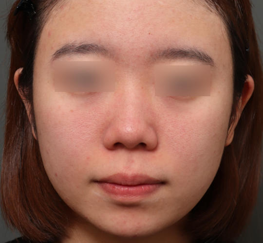 20代女性の肌管理毛穴スリークスキン(ダーマペン4) Before 症例写真