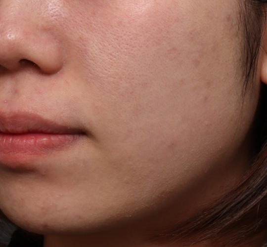 20代女性の肌管理毛穴スリークスキン(ダーマペン4) Before 症例写真