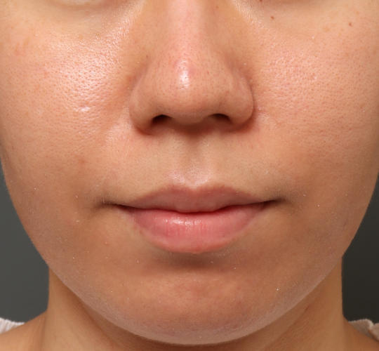 20代女性のピコシュア After 症例写真