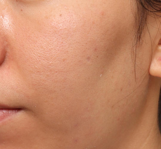 20代女性のピコシュア After 症例写真