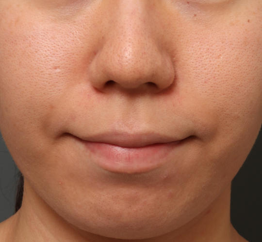 20代女性のピコシュア Before 症例写真