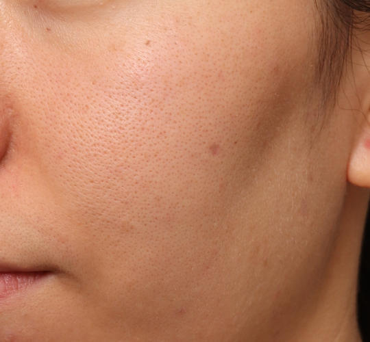 20代女性のピコシュア Before 症例写真