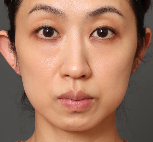 40代女性の3Dリポアイリフト  Before 症例写真