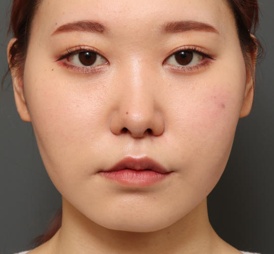 20代女性の目頭切開 After 症例写真