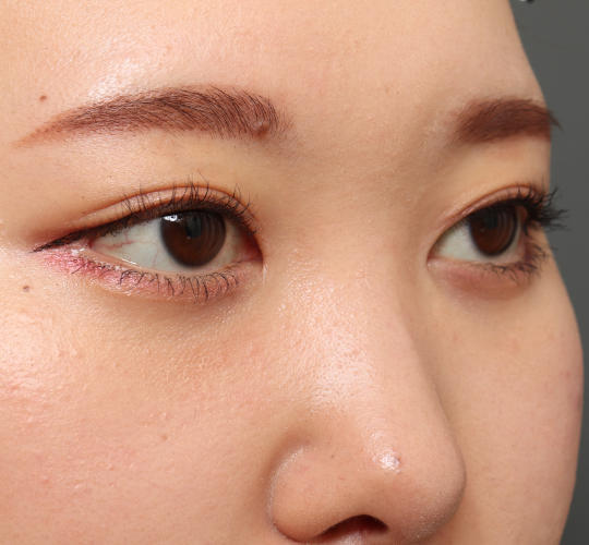 20代女性の目尻切開 After 症例写真