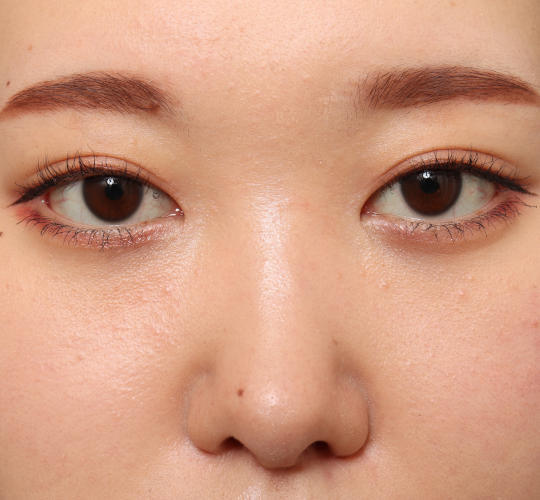 20代女性の目尻切開 After 症例写真
