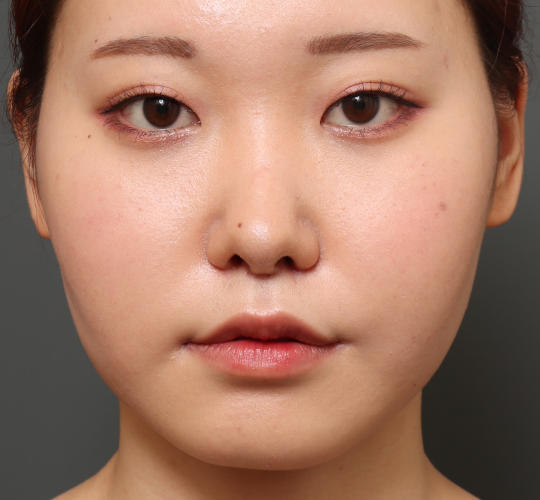 20代女性の目頭切開 Before 症例写真