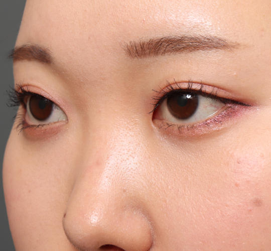 20代女性の目尻切開 Before 症例写真