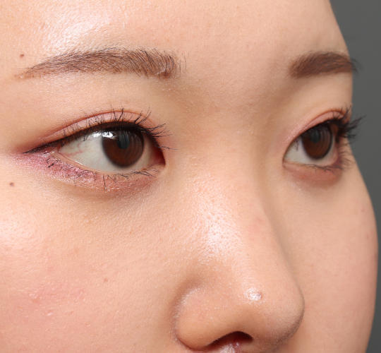 20代女性の目尻切開 Before 症例写真