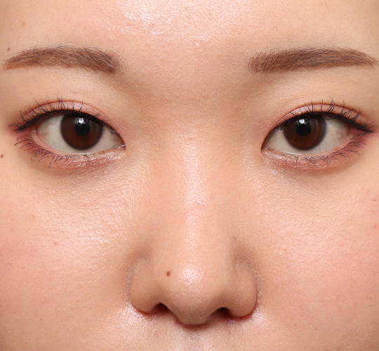 20代女性の目尻切開 Before 症例写真