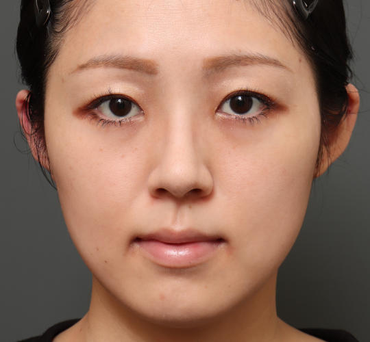 30代女性の顔の脂肪吸引  Before 症例写真