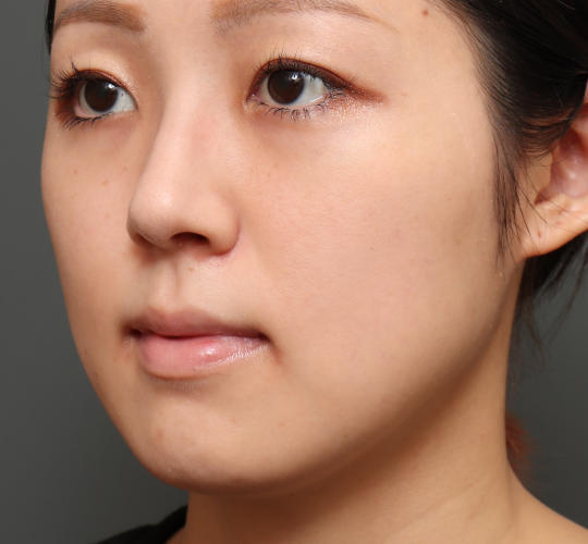 30代女性の顔の脂肪吸引  Before 症例写真