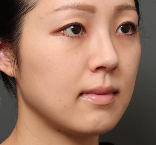 30代女性の顔の脂肪吸引  Before 症例写真