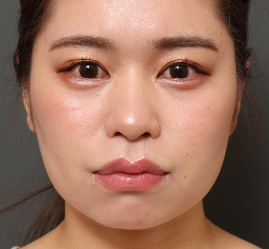 20代女性の人中短縮(リップリフト) After 症例写真