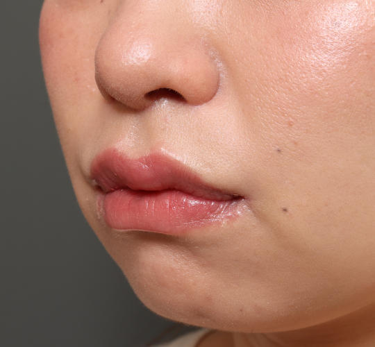 20代女性の人中短縮(リップリフト) After 症例写真