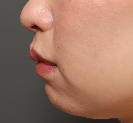 20代女性の人中短縮(リップリフト) After 症例写真